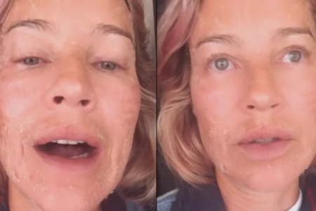 Rosto com descamação de Luana Piovani