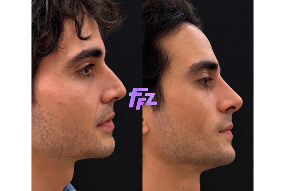 Fiuk faz harmonização facial e mostra resultado; veja antes e depois Objetivo era fazer ajustes no rosto sem a realização de cortes