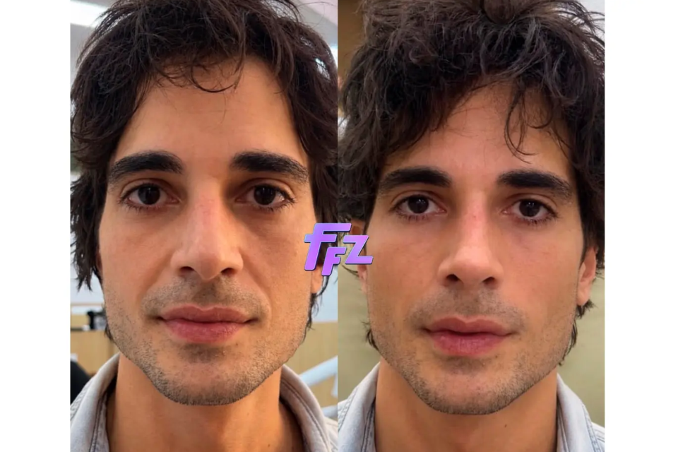 Fiuk faz harmonização facial e mostra resultado; veja antes e depois Objetivo era fazer ajustes no rosto sem a realização de cortes
