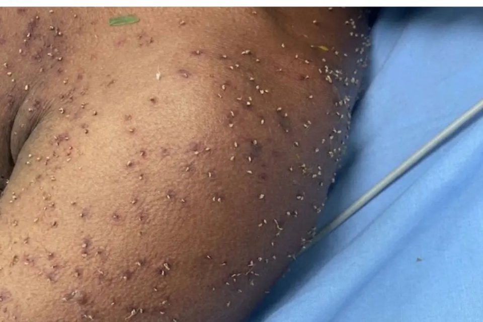 Marcas de múltiplas picadas de abelhas na pele do homem atacado por um enxame na zona rural de Itapuranga